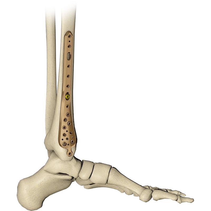 Пластина великогомілкова дистальна медіальна